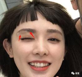 网红打球眉骨受伤图片,眉骨骨折引关注