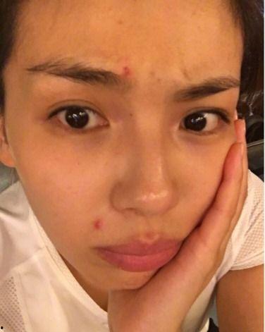 明星会不会长痘